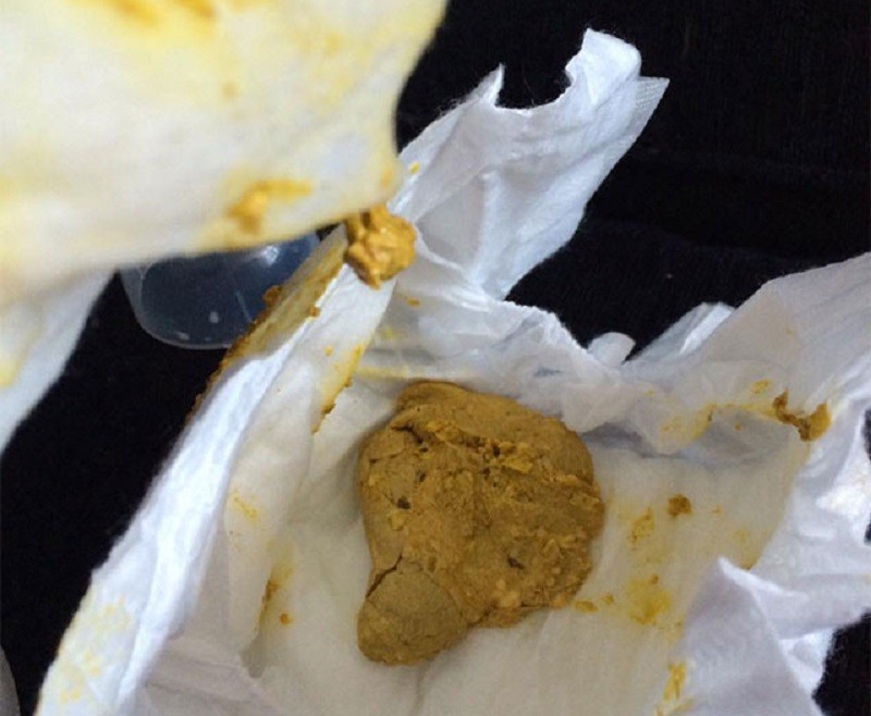 راهنمای تصویری انواع مدفوع نوزاد