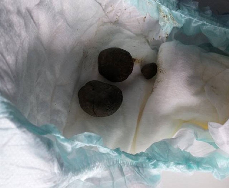 راهنمای تصویری انواع مدفوع نوزاد