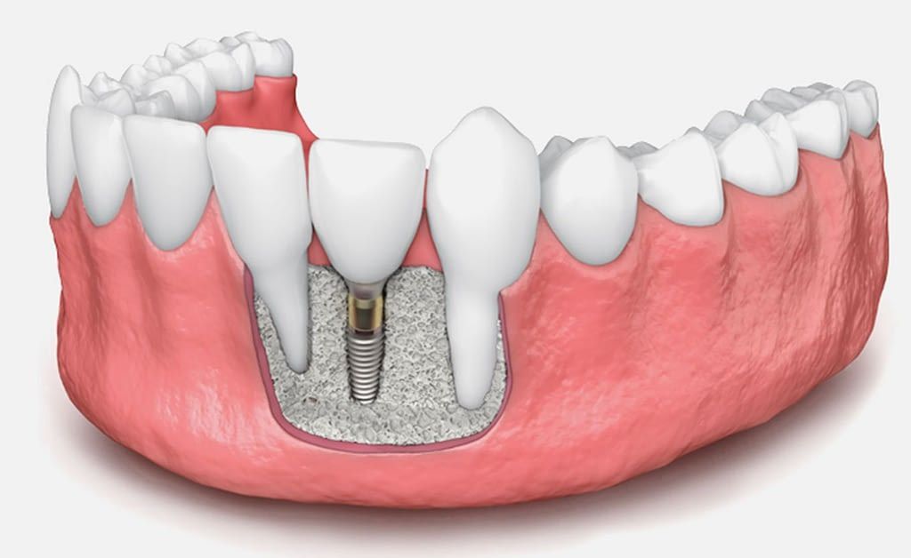 ایمپلنت دندان چیست ؟ ایمپلنت دندان چیست ؟