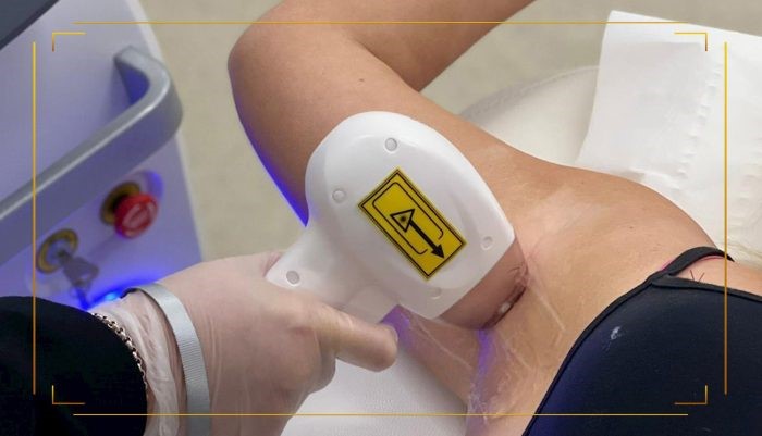 دستگاه لیزر تیتانیوم خوبه؟ بررسی این دستگاه لیزر محبوب