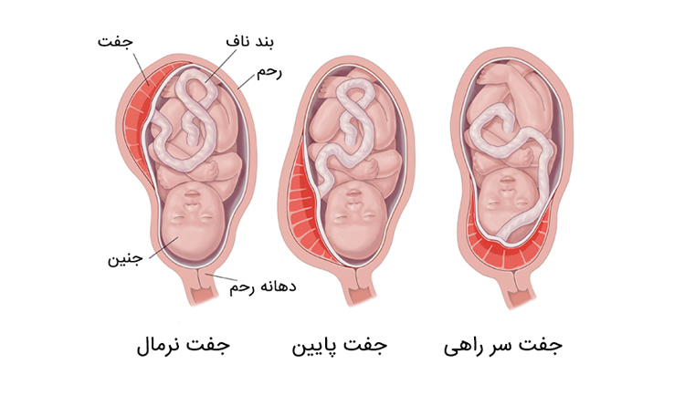 جفت سر راهی چیست؟