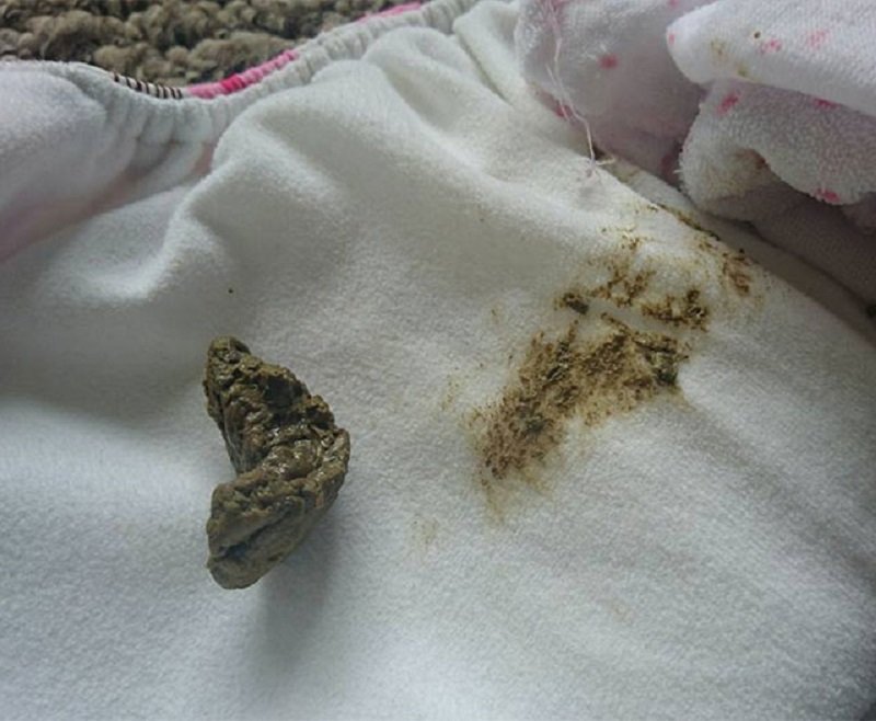 راهنمای تصویری انواع مدفوع نوزاد