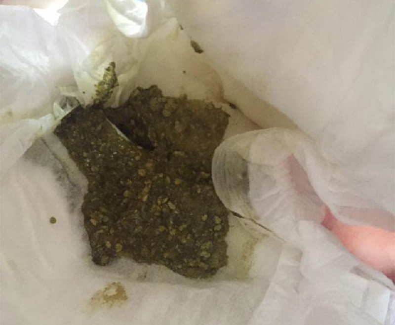 راهنمای تصویری انواع مدفوع نوزاد