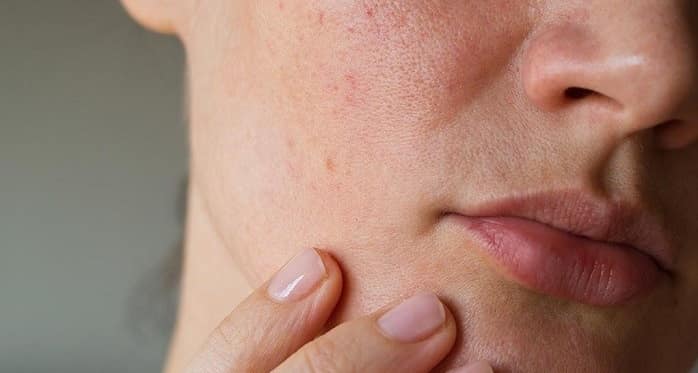 عوارض جانبی هیدروژن پراکسید