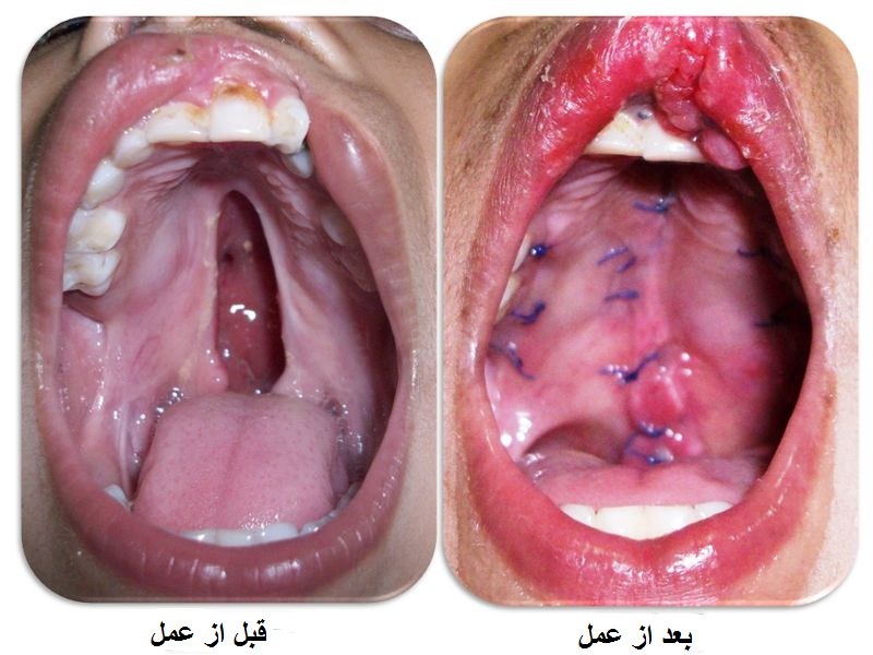 اطلاعاتی در خصوص شکاف کام