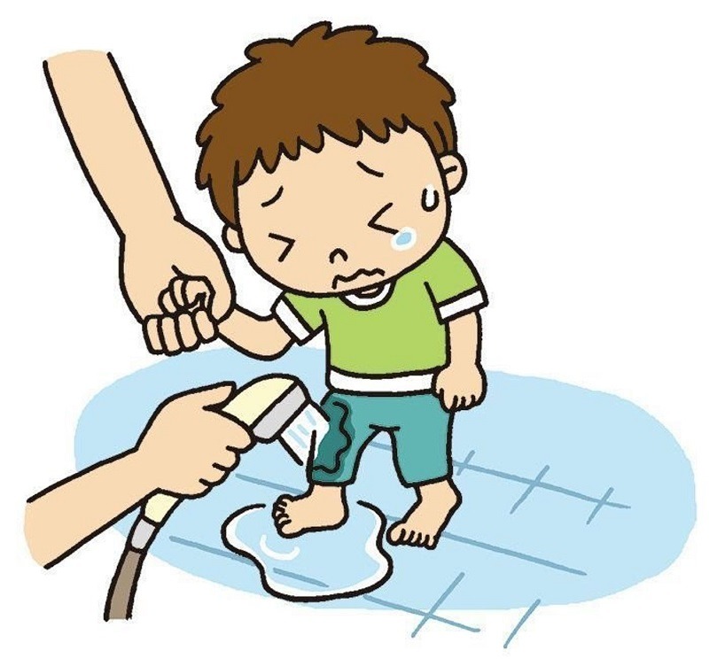 کمک های اولیه به هنگام سوختگی شیرخوار کمک های اولیه به هنگام سوختگی شیرخوار