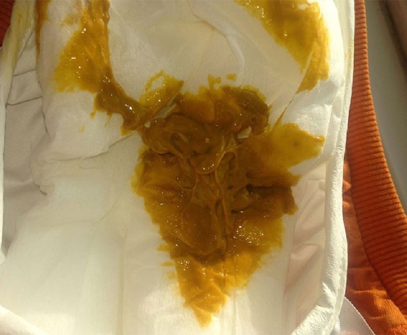 راهنمای تصویری انواع مدفوع نوزاد