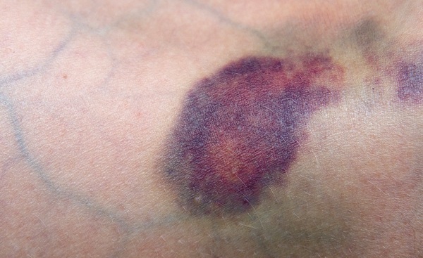 موارد استفاده و عوارض قرص پلاویکس موارد استفاده و عوارض قرص پلاویکس