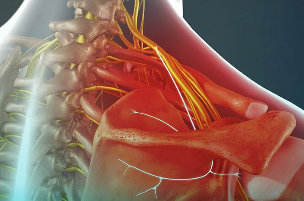 Лечение невралгии плечевого нерва