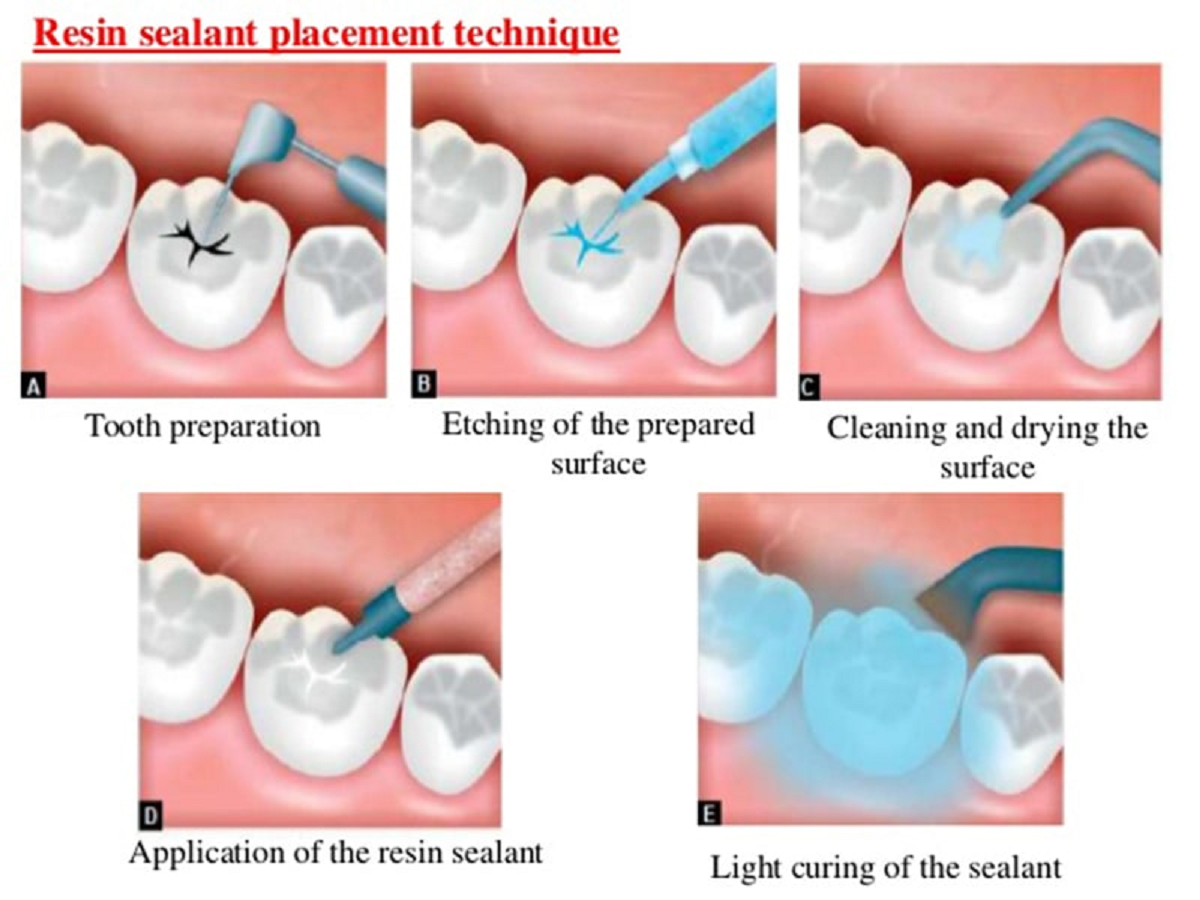 Герметизация фиссур. Герметизация фиссур этапы. Неинвазивная герметизация фиссур. Герметизация фиссур премоляров.