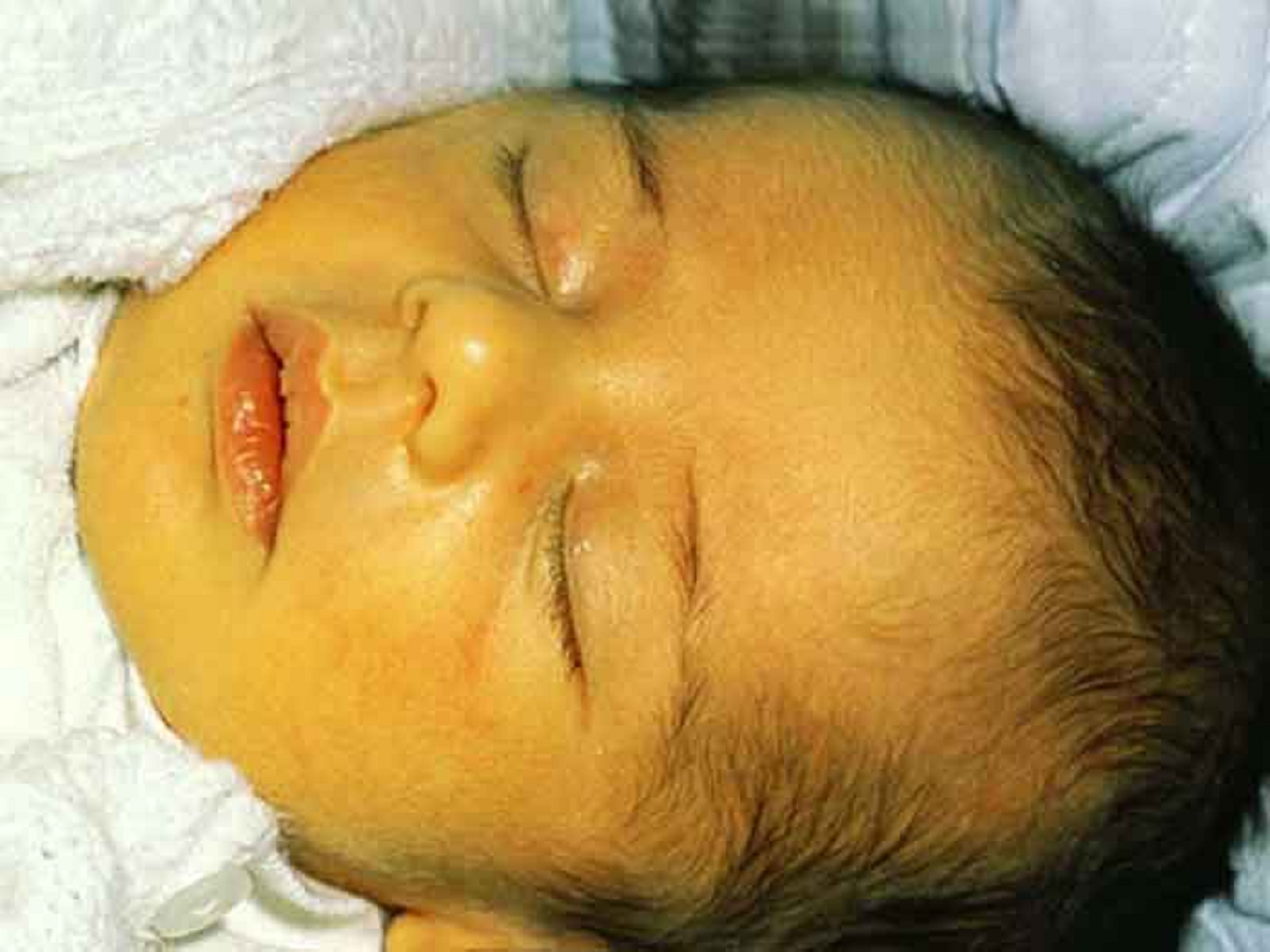 Билирубиновая энцефалопатия у новорожденных