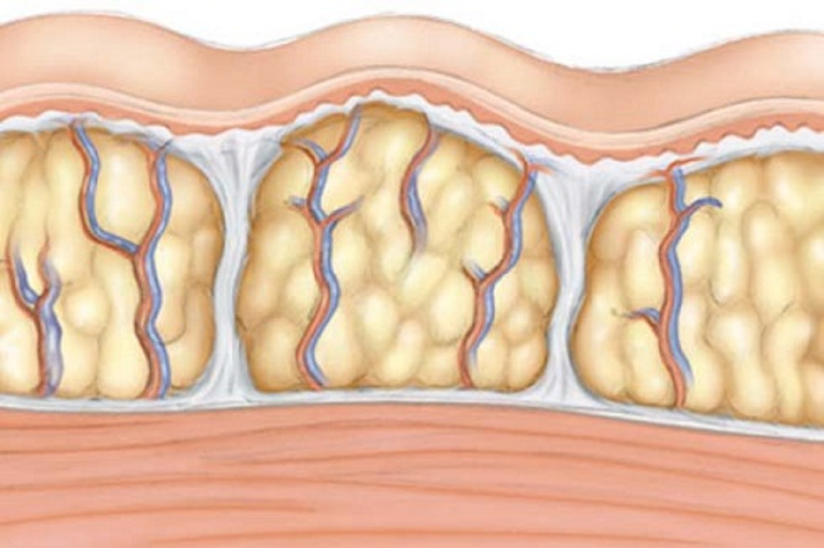 Жировая кожа. Целлюлит подкожный жир. Целлюлит в разрезе.