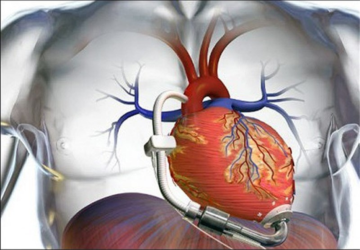 Проходит сердце. Имплантация искусственного сердца. Искусственные сосуды для сердца. Электронное сердце для человека. Операция искусственный желудочек сердца.