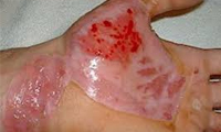  انواع سوختگی و درمان‌های فوری آنها