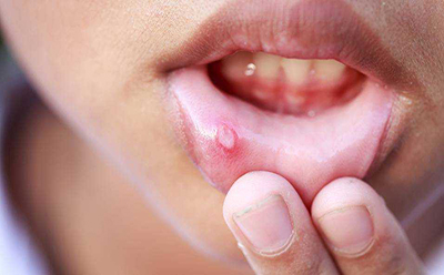 آیا آفت دهان همان تبخال است؟