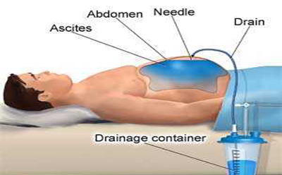  آسیت یا آب آوردن شکم