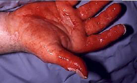 كمك&zwnj;هاي اوليه در سوختگی