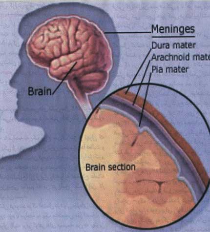 مننژيت؛ عفونت مغز