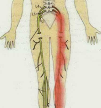 بررسي علل و روش درمان بيماري طولاني ترين عصب بدن