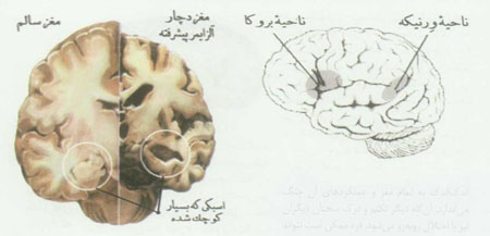 آلزايمر هيچ ربطي به زبان پريشي ندارد! (1)