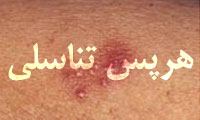 هرپس تناسلى