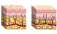 سلوليت يا التهاب سلول&rlm;ها 