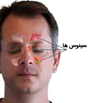 درمان خانگی مشکلات سینوس&zwnj;ها