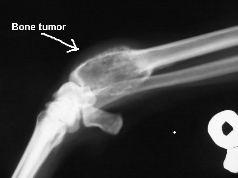 سرطان استخوان (Bone Cancer)