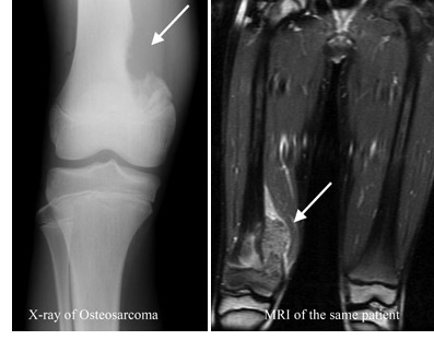 سرطان استخوان (Bone Cancer)