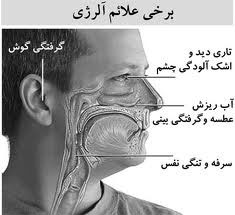 آلرژی