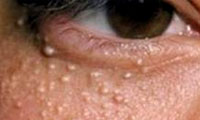  دانه‌های سفید زیرچشم