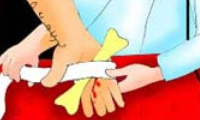 استخوان، لای زخم می‌گذارد