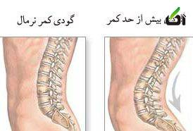 گودی کمر و علل آن