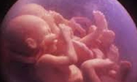    15 نکته درباره بارداری چندقلویی