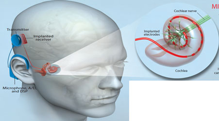 پروتزهای شنوایی؛ مطالعه، طراحی و چالش‌های طراحی