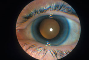 در مورد بیماری‌های چشم چه می‌دانید؟