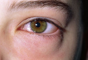 در مورد بیماری‌های چشم چه می‌دانید؟