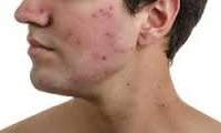 معالجات طبیعی آکنه