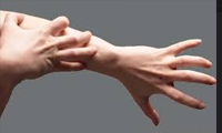  علل خارش شدید