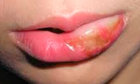 چگونه تورم لب‌ها را سریع کاهش دهیم