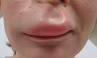 تورم لب بالایی 