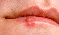 زخم سرد روی لب‌ها
