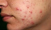 پاکسازی طبیعی آکنه