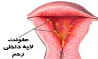 علائم عفونت باکتریایی واژینال